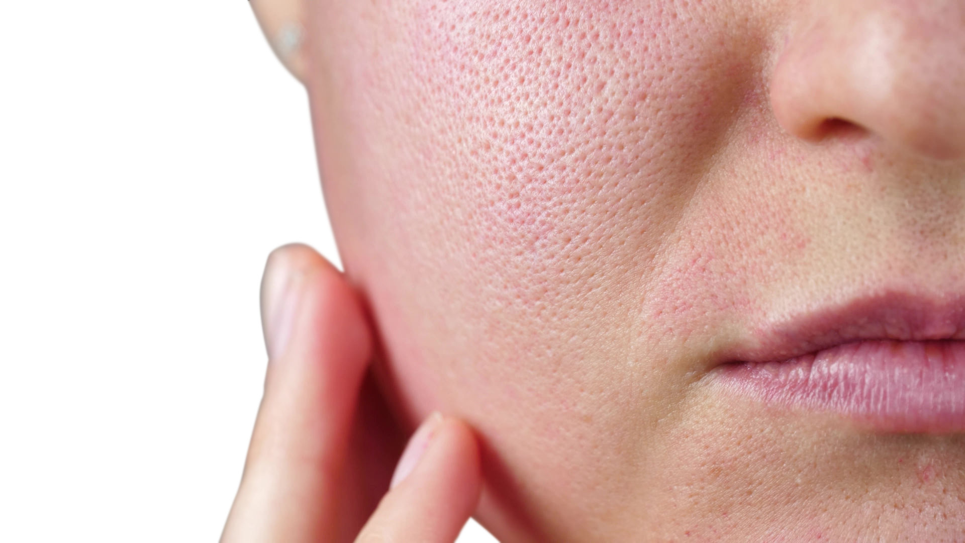 Does Dehydrated Skin Cause Large Pores At Gail Hendershot Blog