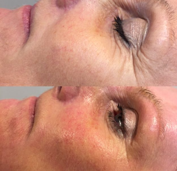 Dermapen Micro-needling before and after