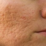 acne treatment Kensington and Wimbledon