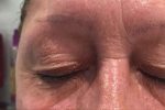 Drooping eyelid treatment wimbledon causes