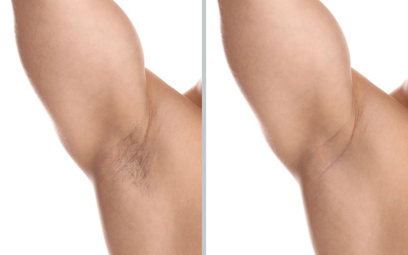 Laser hair removal for men