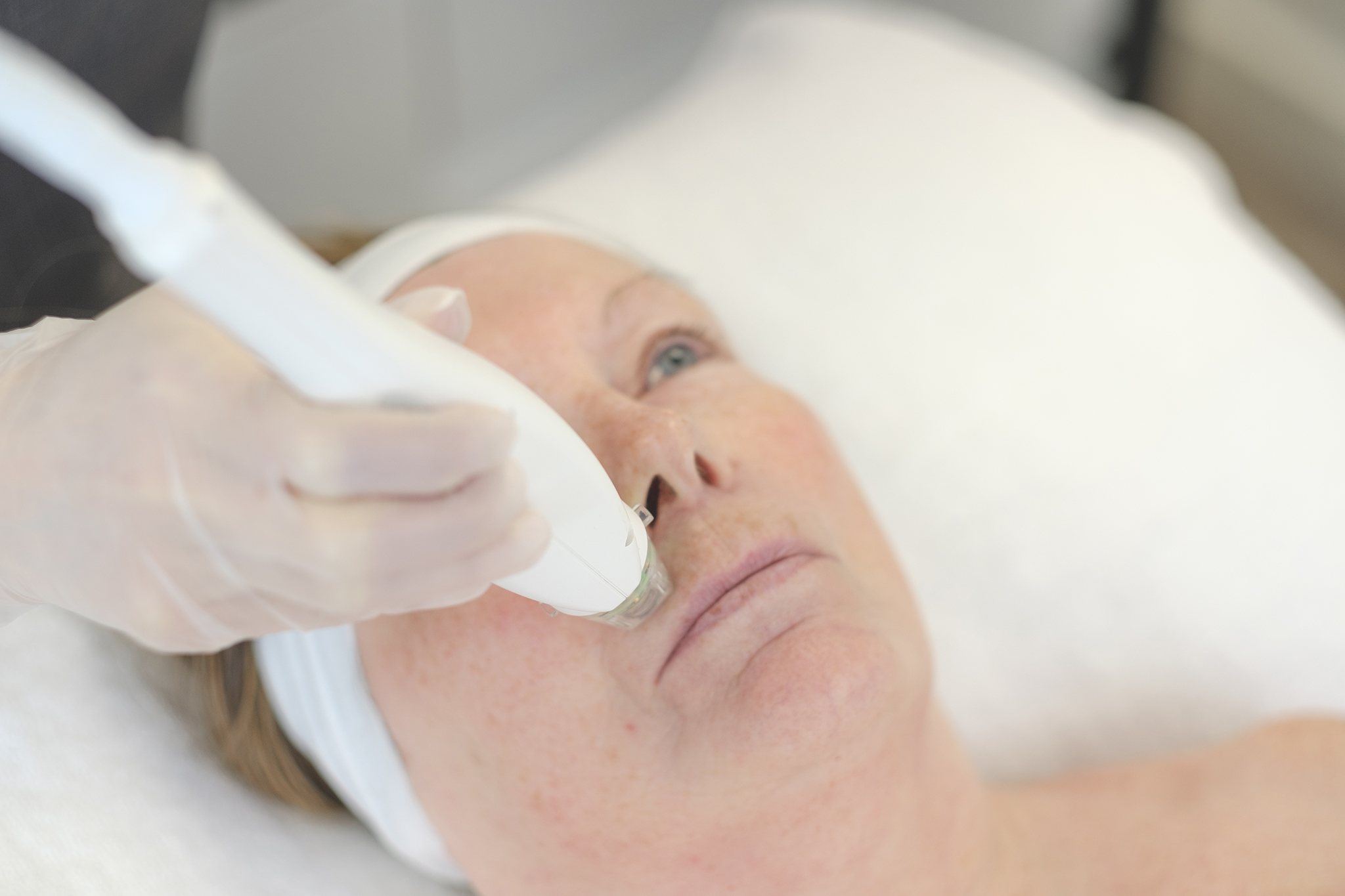 Radio Frequency Microneedling